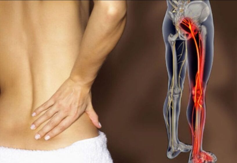Read more about the article What is Sciatica