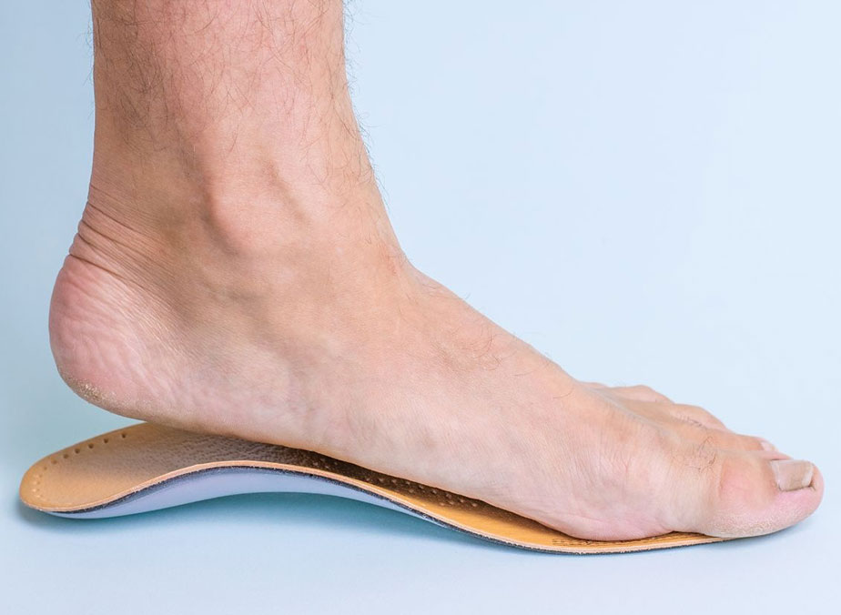 Understanding and Managing Flat Feet