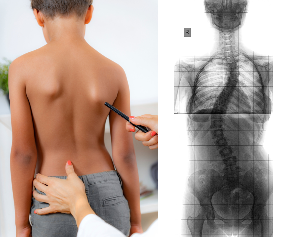 Understanding and Managing Scoliosis