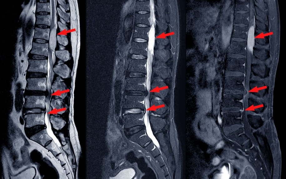 Why Your Scan Doesn’t Explain Your Back Pain (And What Really Does)
